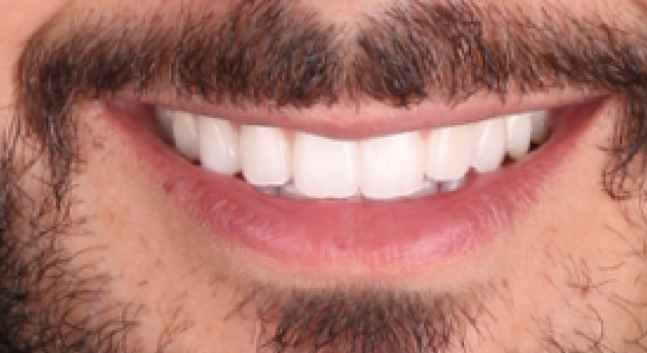 caso real antes y despues implantes dentales