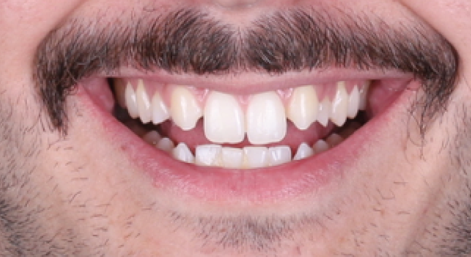 caso real antes y despues implantes dentales