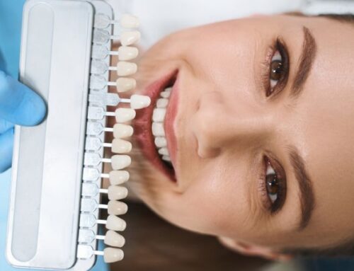 Carillas dentales antes y después: 4 casos reales con foto