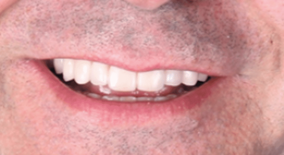 caso real antes y despues implantes dentales