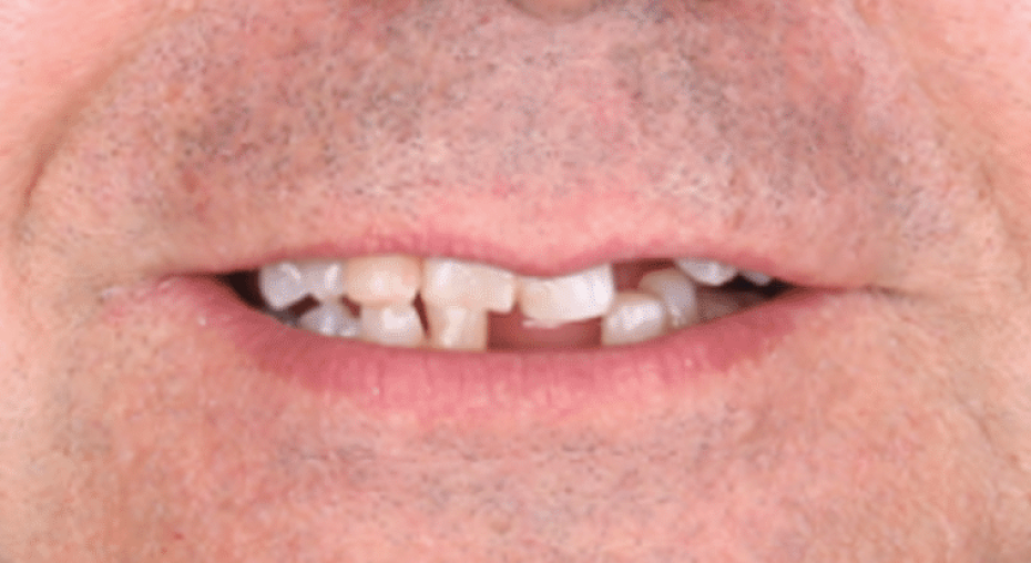 caso real antes y despues implantes dentales
