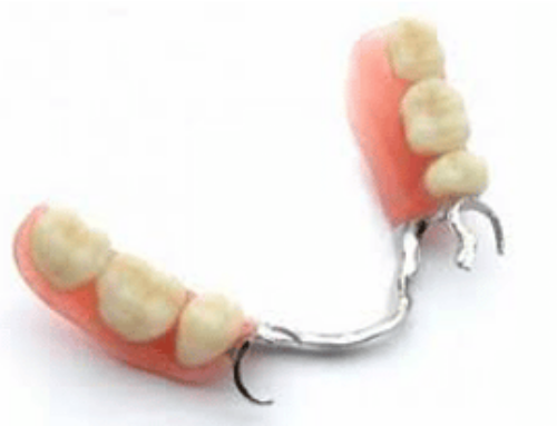 ¿Qué son las prótesis dentales?