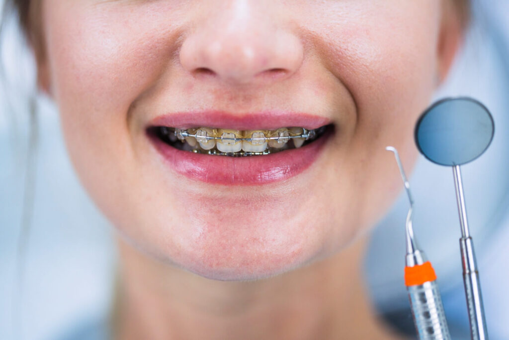 Alimentos que no se pueden comer con brackets