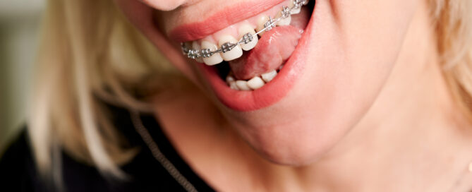 no deberias comer esto con brackets