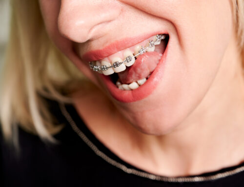 Alimentos que no se pueden comer con brackets